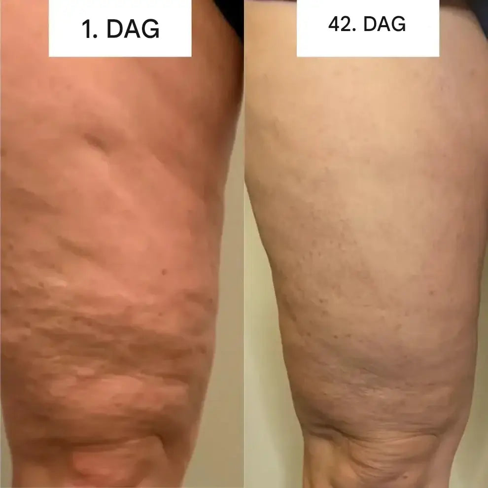 CelluGlow - Minska celluliter och bristningar